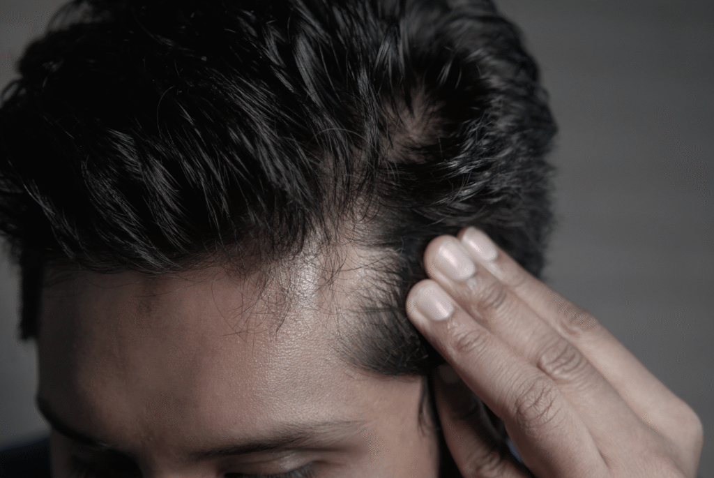 a man showing hair loss in head