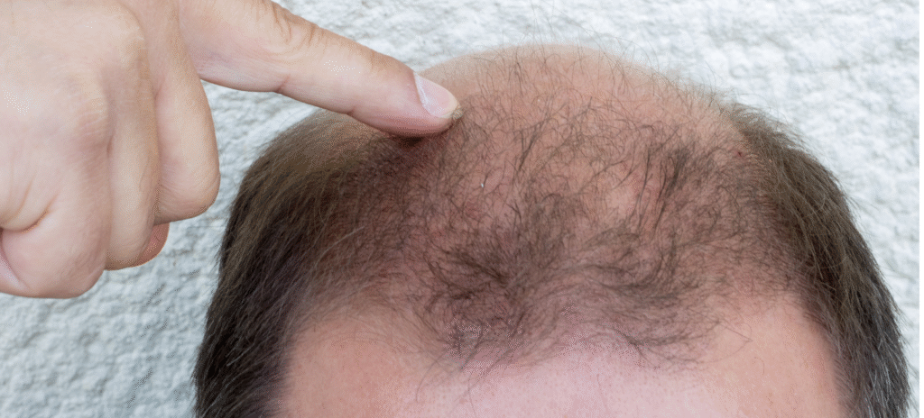 A head of man showing hair loss for blog Hair Loss Guide for Men